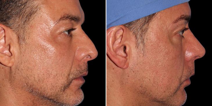 Male Open Rhinoplasty Before & After 3/4 Right View